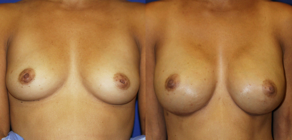 BREAST RECONSTRUCTION AFTER MASTECTOMY