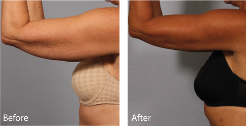 Female Coolsculpting Results 1