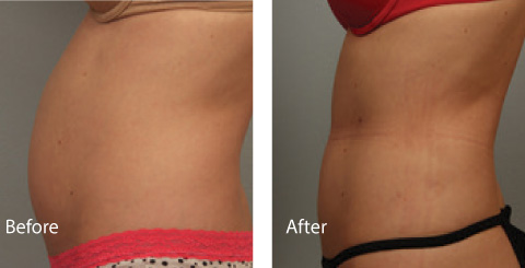 Male Coolsculpting Results 2
