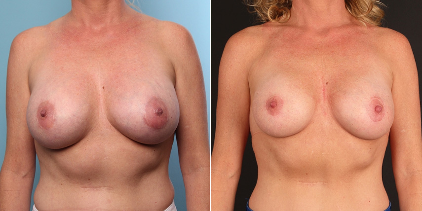 Orange County Breast Implant Removal 1