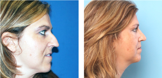 Rhinoplasty Before and After photos