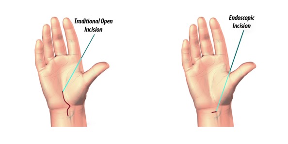 Carpal Tunnel Syndrome Surgery | Irvine, California