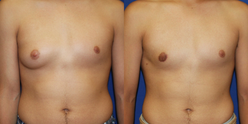Gynecomastia before and after photo