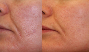 Laser Genesis Treatment