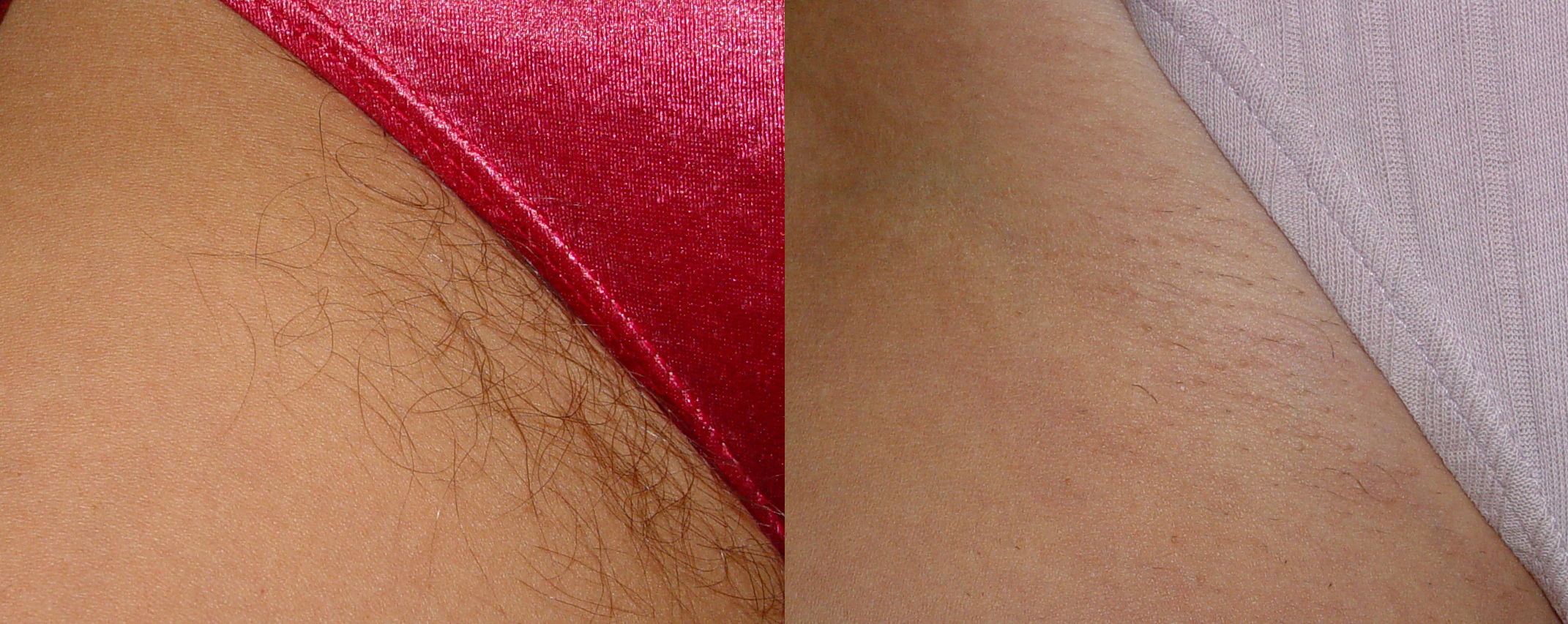 Laser Hair Removal Orange County CA Options Laser Hair Removal Orange County CA Options
