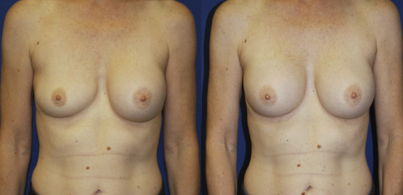 Breast Asymmetry correction