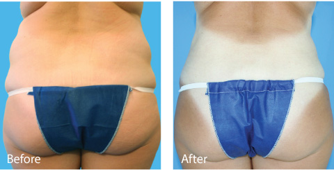 Female Coolsculpting Results 2
