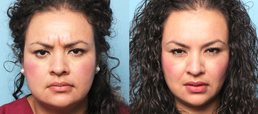 Botox Results 1