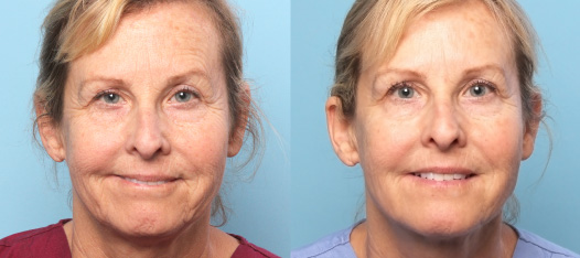Botox Results 2