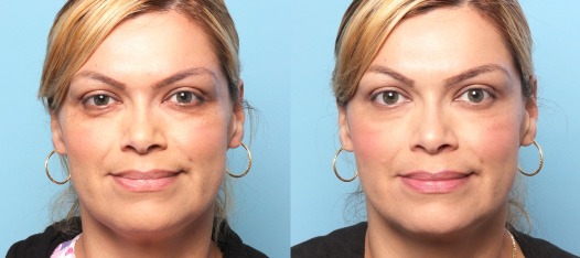 Botox Results 3