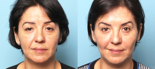 Botox Results 4