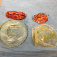 Orange County Breast Implant removal and capsulectomy 8