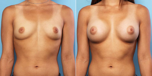 Finesse Breast Augmentation Results 1