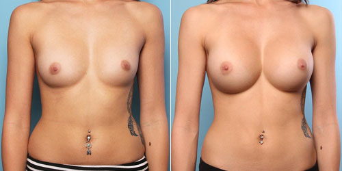 Finesse Breast Augmentation Results 4