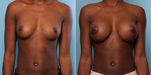 Finesse Breast Augmentation Results 3