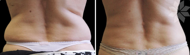 Coolsculpting 3