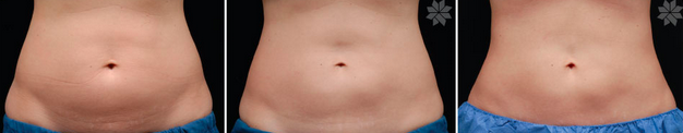 Coolsculpting 4