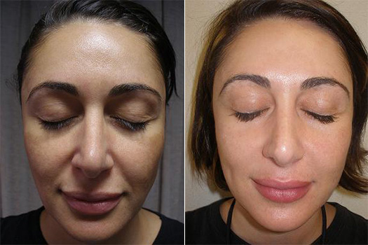 Cosmelan Peel