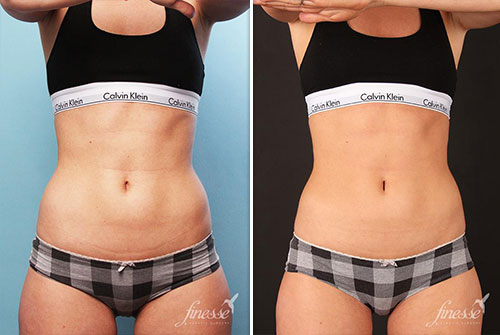 Female Coolsculpting Results 2