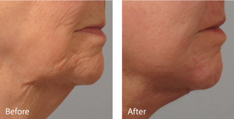 Female Coolsculpting Results 1
