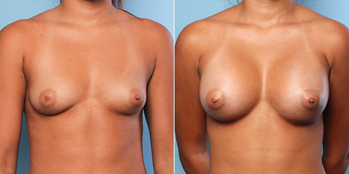 Finesse Breast Augmentation Results 2