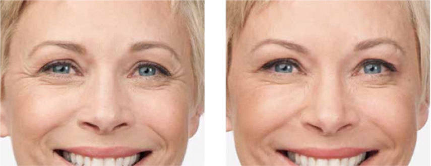 Wrinkle Treatment Options